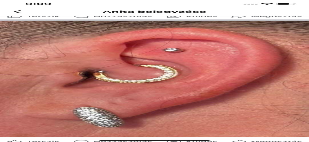 Gyógypiercing